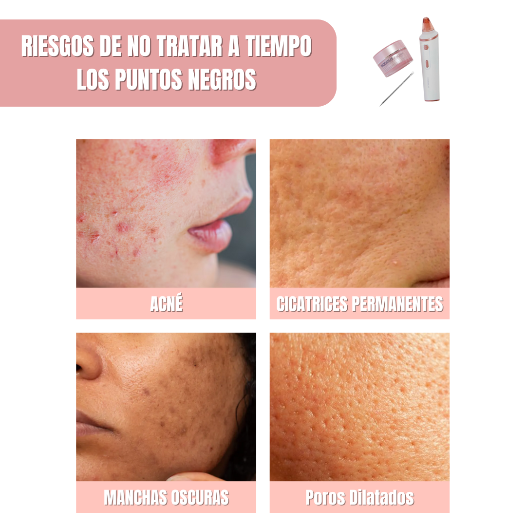 Extractor de puntos negros + Mascarilla + Espátula